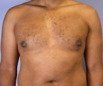 Breast Reduction (for Men)