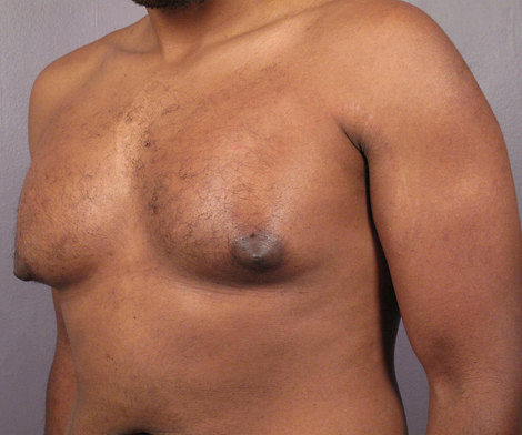 Breast Reduction (for Men) before and after photo