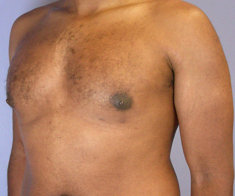 Breast Reduction (for Men) before and after photo