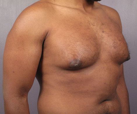 Breast Reduction (for Men) before and after photo