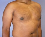 Breast Reduction (for Men) Before and after photo