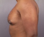 Breast Reduction (for Men) Before and after photo