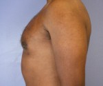 Breast Reduction (for Men) Before and after photo