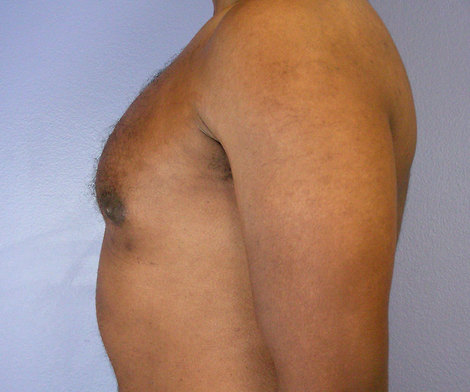 Breast Reduction (for Men) before and after photo