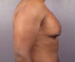 Breast Reduction (for Men) Before and after photo