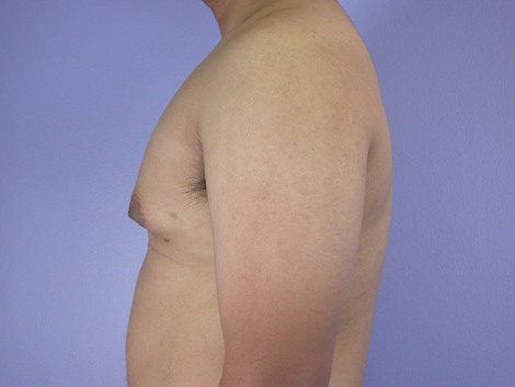 Breast Reduction (for Men) before and after photo