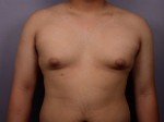 Breast Reduction (for Men) Before and after photo