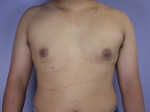 Breast Reduction (for Men)