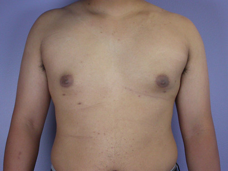 Breast Reduction (for Men) before and after photo