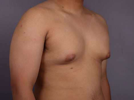 Breast Reduction (for Men) before and after photo