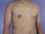 Breast Reduction (for Men)