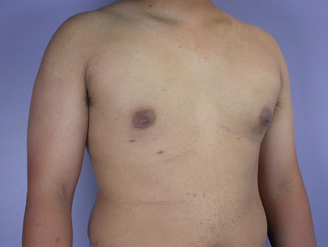 Breast Reduction (for Men) before and after photo