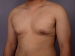 Breast Reduction (for Men) Before and after photo