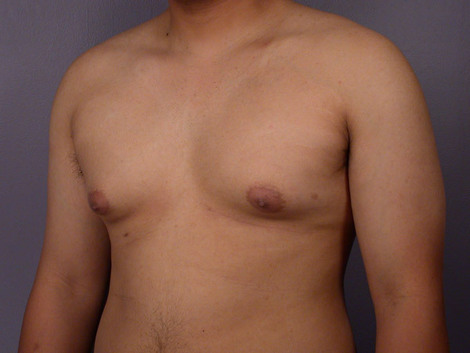 Breast Reduction (for Men) before and after photo