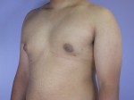 Breast Reduction (for Men) Before and after photo