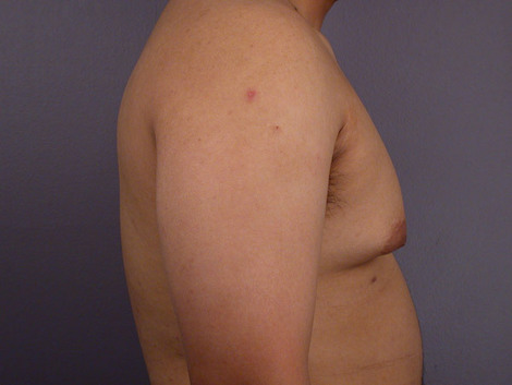 Breast Reduction (for Men) before and after photo