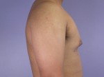 Breast Reduction (for Men) Before and after photo