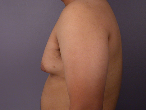 Breast Reduction (for Men) before and after photo