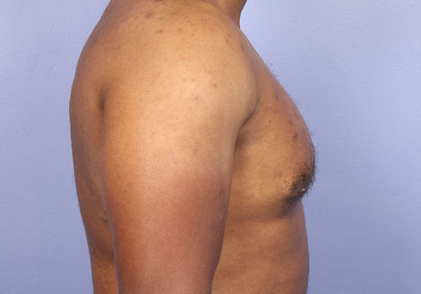 Breast Reduction (for Men) before and after photo