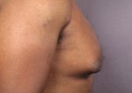 Breast Reduction (for Men) Before and after photo