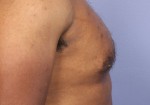 Breast Reduction (for Men) Before and after photo