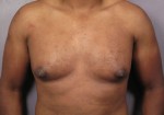 Breast Reduction (for Men)