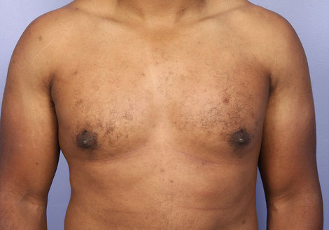 Breast Reduction (for Men) before and after photo