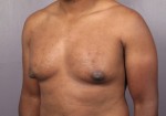 Breast Reduction (for Men)