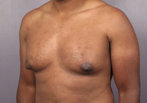 Breast Reduction (for Men) before and after photo