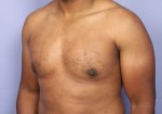 Breast Reduction (for Men)