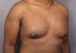 Breast Reduction (for Men) Before and after photo