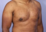 Breast Reduction (for Men) Before and after photo