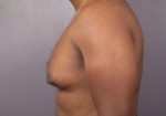 Breast Reduction (for Men) Before and after photo