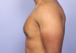 Breast Reduction (for Men) Before and after photo