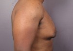 Breast Reduction (for Men) Before and after photo