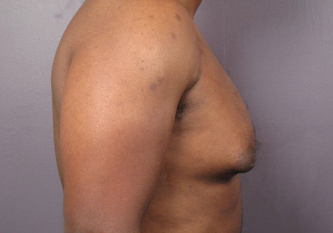 Breast Reduction (for Men) before and after photo