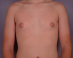 Breast Reduction (for Men)