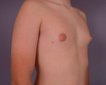 Breast Reduction (for Men) before and after photo