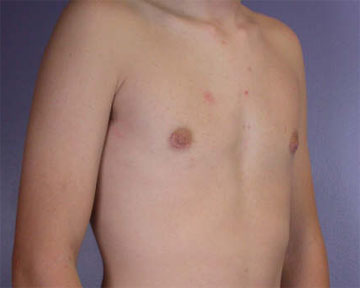 Breast Reduction (for Men) before and after photo