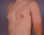 Breast Reduction (for Men) Before and after photo