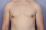 Breast Reduction (for Men) Before and after photo