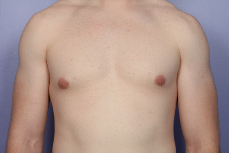 Breast Reduction (for Men) before and after photo