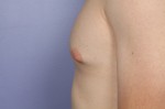 Breast Reduction (for Men) Before and after photo