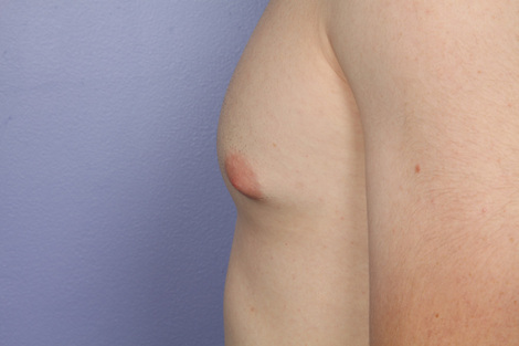 Breast Reduction (for Men) before and after photo