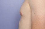 Breast Reduction (for Men) Before and after photo