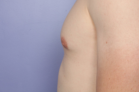 Breast Reduction (for Men) before and after photo