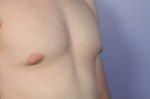 Breast Reduction (for Men) Before and after photo