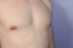 Breast Reduction (for Men) Before and after photo