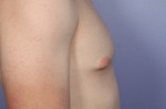 Breast Reduction (for Men) Before and after photo