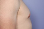 Breast Reduction (for Men) Before and after photo